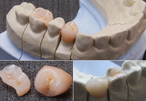 ハイブリッドクラウン＆ハイブリッドインレー